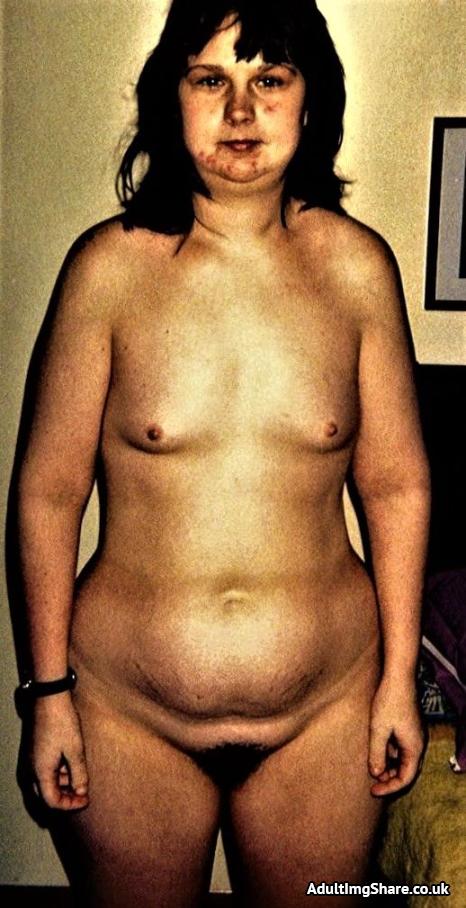 Shelley before tit surgery